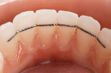 contention-orthodontie