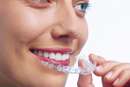 les-gouttières-d’alignement les-gouttières-d’alignement