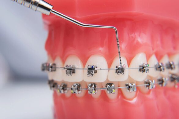 Damon-Metal-self-ligating-braces Damon-Metal-self-ligating-braces