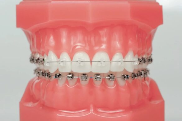 Damon_Clear_Q_Typodont Damon_Clear_Q_Typodont