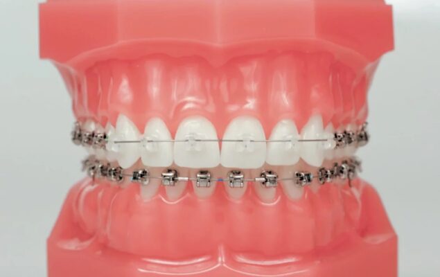 Damon_Clear_Q_Typodont