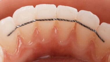 contention-orthodontie-380x215